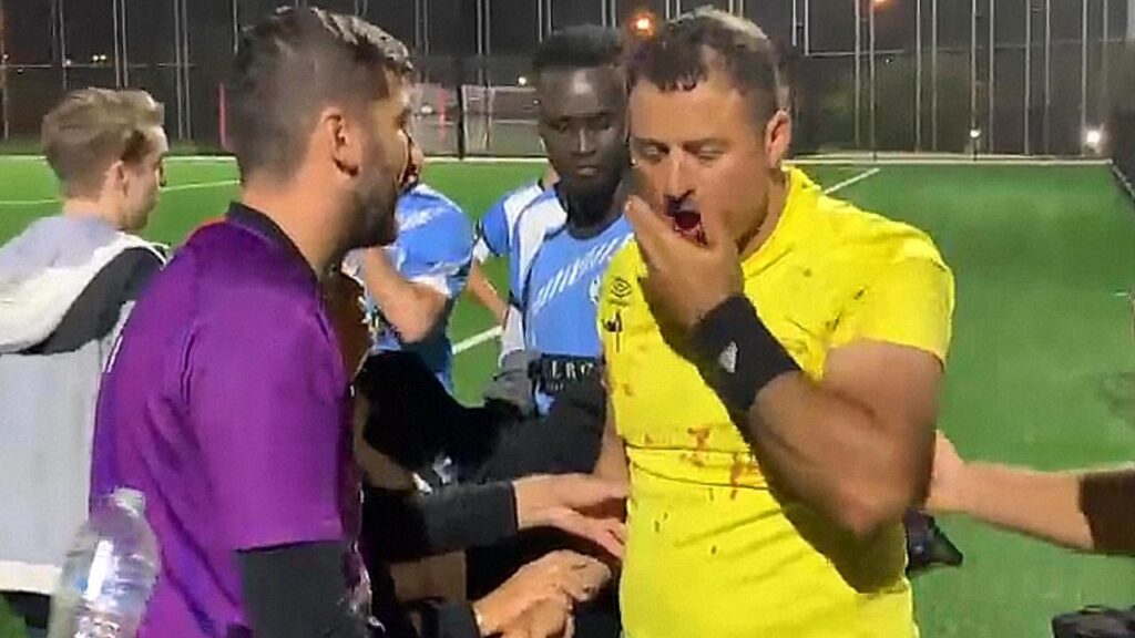 Çmendet futbollisti, i thyen nofullën dhe disa dhëmbë arbitrit